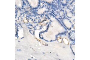 Immunohistochemistry of paraffin-embedded human thyroid cancer using eNOS Rabbit mAb (ABIN7268920) at dilution of 1:200 (40x lens). (ENOS anticorps)