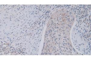 Detection of JAM2 in Human Lung cancer Tissue using Polyclonal Antibody to Junctional Adhesion Molecule 2 (JAM2)