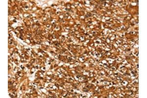 The image on the left is immunohistochemistry of paraffin-embedded Human prostate cancer tissue using ABIN7192401(SLC16A3 Antibody) at dilution 1/30, on the right is treated with synthetic peptide. (SLC16A3 anticorps)