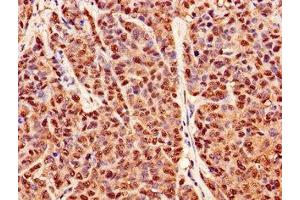 Immunohistochemistry of paraffin-embedded human ovarian cancer using ABIN7162945 at dilution of 1:100