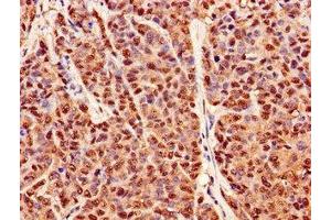 Immunohistochemistry of paraffin-embedded human ovarian cancer using ABIN7162945 at dilution of 1:100 (Peroxiredoxin 6 anticorps  (AA 87-224))