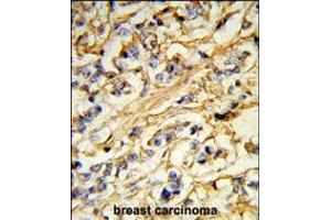Formalin-fixed and paraffin-embedded human breast carcinoma reacted with CHMP4B Antibody (N-term), which was peroxidase-conjugated to the secondary antibody, followed by DAB staining.