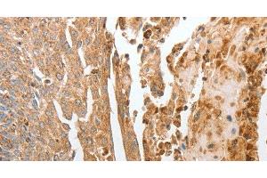 Immunohistochemistry of paraffin-embedded Human cervical cancer using NPY1R Polyclonal Antibody at dilution of 1:30 (NPY1R anticorps)