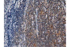 Immunohistochemical staining of paraffin-embedded Human lymphoma tissue using anti-ARHGAP25 mouse monoclonal antibody. (ARHGAP25 anticorps)