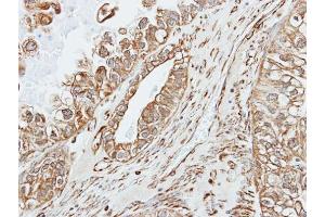 IHC-P Image Immunohistochemical analysis of paraffin-embedded human ovarian cancer, using alpha amylase 2A(pancreatic), antibody at 1:500 dilution. (AMY2A anticorps)