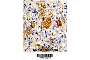 Formalin-fixed and paraffin-embedded human breast carcinoma with C5 Antibody (N-term), which was peroxidase-conjugated to the secondary antibody, followed by DAB staining.