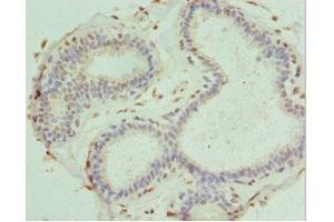 Immunohistochemistry of paraffin-embedded human breast cancer using ABIN7166867 at dilution of 1:100 (PDXK anticorps  (AA 1-312))