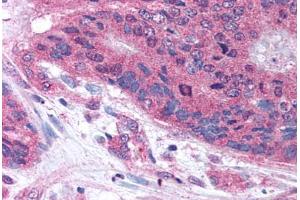 Human Colon Carcinoma (formalin-fixed, paraffin-embedded) stained with PLA2G3 antibody ABIN213634 at 10 ug/ml followed by biotinylated goat anti-rabbit IgG secondary antibody ABIN481713, alkaline phosphatase-streptavidin and chromogen. (PLA2G3 anticorps  (Internal Region))