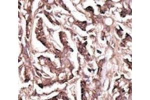 IHC analysis of FFPE human breast carcinoma tissue stained with the APG7 antibody (ATG7 anticorps  (AA 284-313))