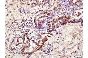 Formalin-fixed and paraffin embedded human lung carcinoma labeled with Rabbit Anti-CD361 Polyclonal Antibody, Unconjugated  at 1:200 followed by conjugation to the secondary antibody and DAB staining (EVI2B anticorps  (AA 151-250))