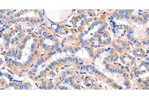 Immunohistochemistry of paraffin-embedded Human thyroid cancer using AMY2A Polyclonal Antibody at dilution of 1:50