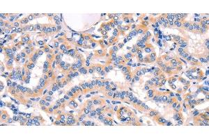 Immunohistochemistry of paraffin-embedded Human thyroid cancer using AMY2A Polyclonal Antibody at dilution of 1:50 (AMY2A anticorps)