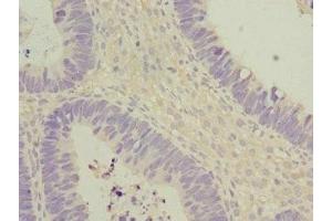 Immunohistochemistry of paraffin-embedded human ovarian cancer using ABIN7172903 at dilution of 1:100 (EIF2B2 anticorps  (AA 1-351))