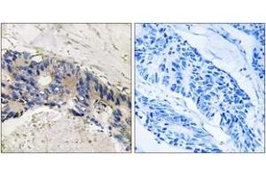 Immunohistochemistry analysis of paraffin-embedded human colon carcinoma tissue, using CA1 Antibody.