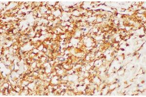 Immunohistochemistry of paraffin-embedded Human kidney cancer using HRAS Polycloanl Antibody at dilution of 1:200 (HRAS anticorps)