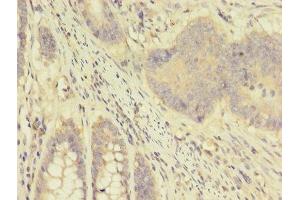 Immunohistochemistry of paraffin-embedded human colon cancer using ABIN7144423 at dilution of 1:100