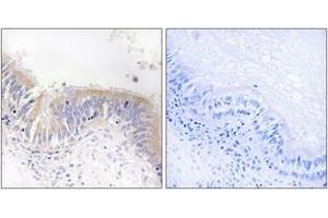 Immunohistochemistry analysis of paraffin-embedded human lung carcinoma tissue, using VGF Antibody. (VGF anticorps  (AA 454-503))