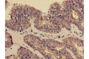 Immunohistochemistry of paraffin-embedded human endometrial cancer using ABIN7148409 at dilution of 1:100 (CD35 anticorps  (AA 901-1095))