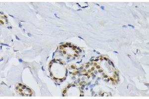 Immunohistochemistry of paraffin-embedded Human breast using BCCIP Polyclonal Antibody at dilution of 1:100 (40x lens). (BCCIP anticorps)