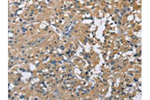 The image on the left is immunohistochemistry of paraffin-embedded Human thyroid cancer tissue using ABIN7128713(CAB39L Antibody) at dilution 1/40, on the right is treated with fusion protein. (CAB39L anticorps)