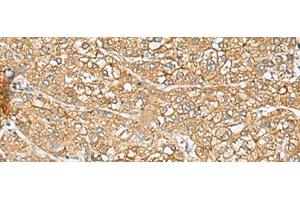 Immunohistochemistry of paraffin-embedded Human liver cancer tissue using C1orf112 Polyclonal Antibody at dilution of 1:110(x200) (C1orf112 anticorps)