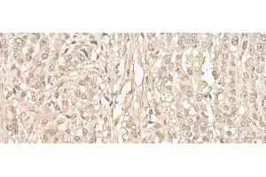 Immunohistochemistry of paraffin-embedded Human ovarian cancer tissue using FYTTD1 Polyclonal Antibody at dilution of 1:30(x200) (FYTTD1 anticorps)