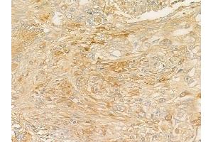 ABIN6257094 and ABIN6275278 at 1/100 staining human lung squamous cell carcinoma by IHC-P. (CYB5R3 anticorps  (C-Term))