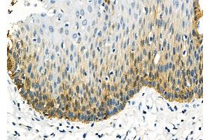 ABIN6259942 and ABIN6277949 at 1/100 staining Human esophageal cancer and adjacent normal tissues by IHC-P. (ANO1 anticorps  (Internal Region))