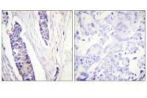 Immunohistochemistry analysis of paraffin-embedded human breast carcinoma tissue, using Tubulin β antibody.