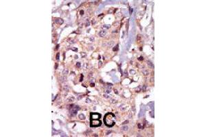 Formalin-fixed and paraffin-embedded human cancer tissue reacted with TEC polyclonal antibody  , which was peroxidase-conjugated to the secondary antibody, followed by AEC staining. (NR4A3 anticorps  (Internal Region))