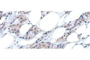Immunohistochemistry of paraffin-embedded Human breast cancer tissue using ANGPTL6 Polyclonal Antibody at dilution of 1:55(x200) (ANGPTL6 anticorps)