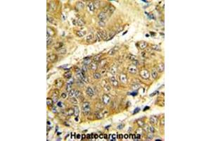 Formalin-fixed and paraffin-embedded human hepatocarcinoma reacted with LTA Antibody (Center), which was peroxidase-conjugated to the secondary antibody, followed by DAB staining. (LTA anticorps  (Middle Region))