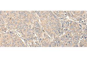 Immunohistochemistry of paraffin-embedded Human liver cancer tissue using C1orf106 Polyclonal Antibody at dilution of 1:80(x200) (C1ORF106 anticorps)