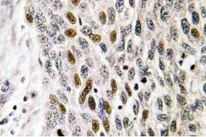 Immunohistochemistry (IHC) analyzes of ATF-1 antibody in paraffin-embedded human lung carcinoma tissue. (AFT1 anticorps)