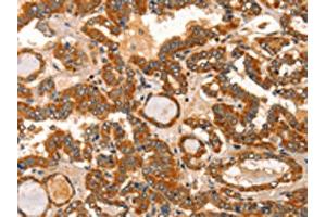 The image on the left is immunohistochemistry of paraffin-embedded Human thyroid cancer tissue using ABIN7129834(IKZF3 Antibody) at dilution 1/60, on the right is treated with fusion protein. (IKZF3 anticorps)