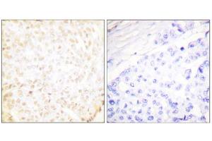 Immunohistochemistry analysis of paraffin-embedded human breast carcinoma tissue using XRCC5 antibody.