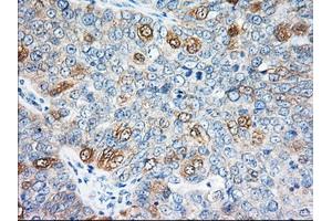 Immunohistochemical staining of paraffin-embedded Adenocarcinoma of Human colon tissue using anti-EIF2S1 mouse monoclonal antibody. (EIF2S1 anticorps)