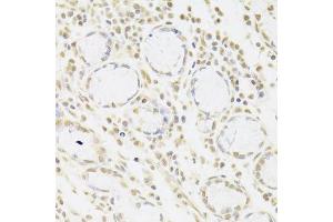 Immunohistochemistry of paraffin-embedded human gastric cancer using SNRPA Antibody. (SNRPA1 anticorps  (AA 1-282))