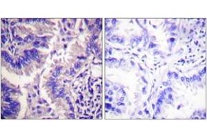 Immunohistochemistry analysis of paraffin-embedded human lung carcinoma tissue, using Caspase 9 (Cleaved-Asp315) Antibody. (Caspase 9 anticorps  (Cleaved-Asp315))