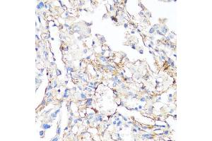 Immunohistochemistry of paraffin-embedded human lung cancer using Fibronectin antibody (ABIN7267194) at dilution of 1:100 (40x lens).