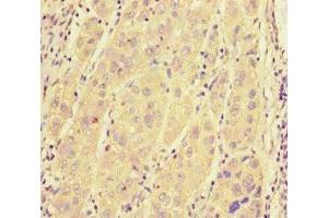 Immunohistochemistry of paraffin-embedded human liver cancer using ABIN7168958 at dilution of 1:100 (SRRM2 anticorps  (AA 248-462))