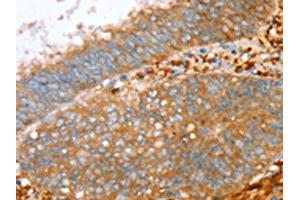 The image on the left is immunohistochemistry of paraffin-embedded Human cervical cancer tissue using ABIN7130778(PTPN7 Antibody) at dilution 1/30, on the right is treated with fusion protein. (PTPN7 anticorps)