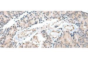 Immunohistochemistry of paraffin-embedded Human prost at e cancer tissue using S100A16 Polyclonal Antibody at dilution of 1:25(x200) (S100A16 anticorps)