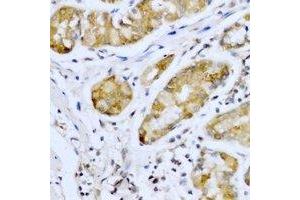Immunohistochemical analysis of SMYD4 staining in human stomach cancer formalin fixed paraffin embedded tissue section. (SMYD4 anticorps)