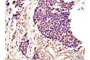 Formalin-fixed and paraffin embedded human lung cancer labeled with Anti-SNAI2/SLUG Polyclonal Antibody, Unconjugated (ABIN685747) followed by conjugation to the secondary antibody and DAB staining (SLUG anticorps  (AA 5-120))