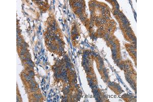Immunohistochemistry of Human lung cancer using MAD2L1BP Polyclonal Antibody at dilution of 1:60