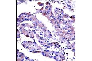 AKT2 Antibody (Center) ((ABIN391023 and ABIN2841193))immunohistochemistry analysis in formalin fixed and paraffin embedded human lung adenocarcinoma followed by peroxidase conjugation of the secondary antibody and DAB staining.