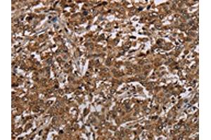 The image on the left is immunohistochemistry of paraffin-embedded Human liver cancer tissue using ABIN7192743(TBX5 Antibody) at dilution 1/35, on the right is treated with synthetic peptide.