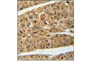 Immunohistochemistry analysis in Formalin Fixed and Paraffin Embedded Human hepatocarcinoma using RT4I1 Antibody (C-term) followed by peroxidase conjugation of the secondary antibody and DAB staining. (RTN4IP1 anticorps  (C-Term))