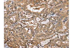 The image on the left is immunohistochemistry of paraffin-embedded Human thyroid cancer tissue using ABIN7191987(PPP2R3A Antibody) at dilution 1/30, on the right is treated with synthetic peptide. (PPP2R3A anticorps)